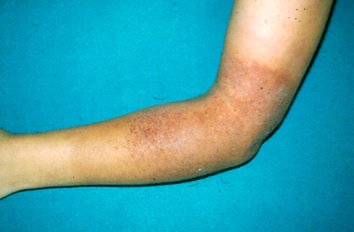 Dermatitis De