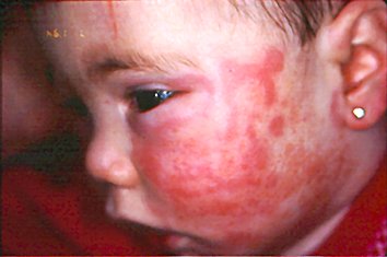 Urticaria alérgica